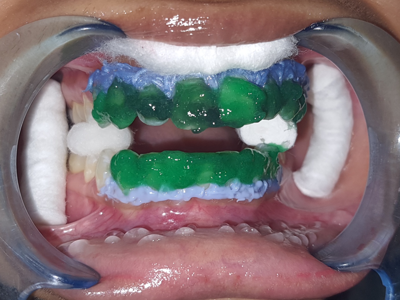 Dental Treatment