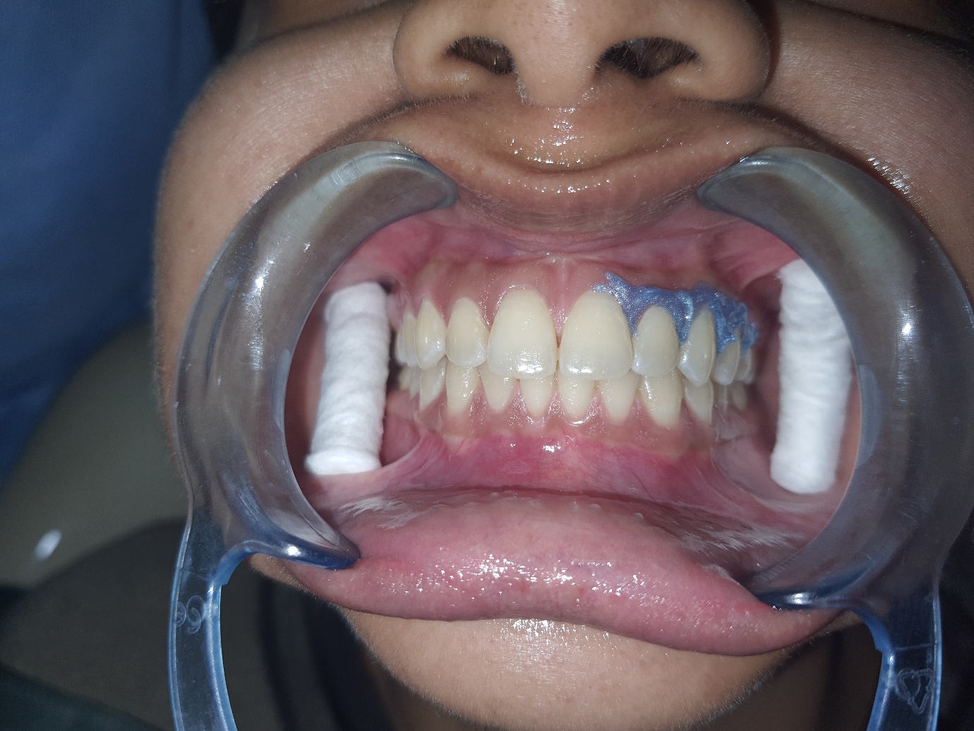 Dental Treatment