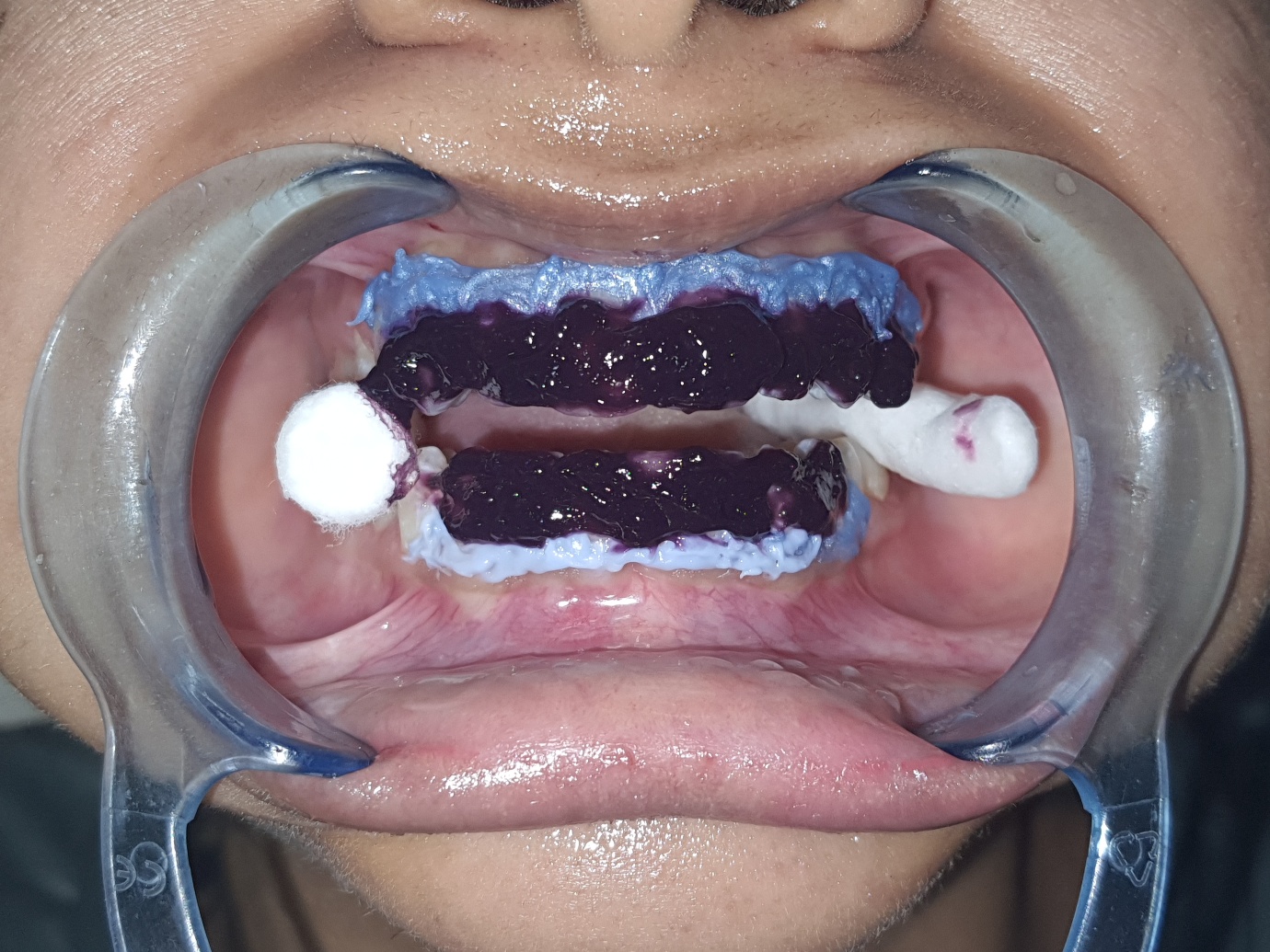 Dental Treatment
