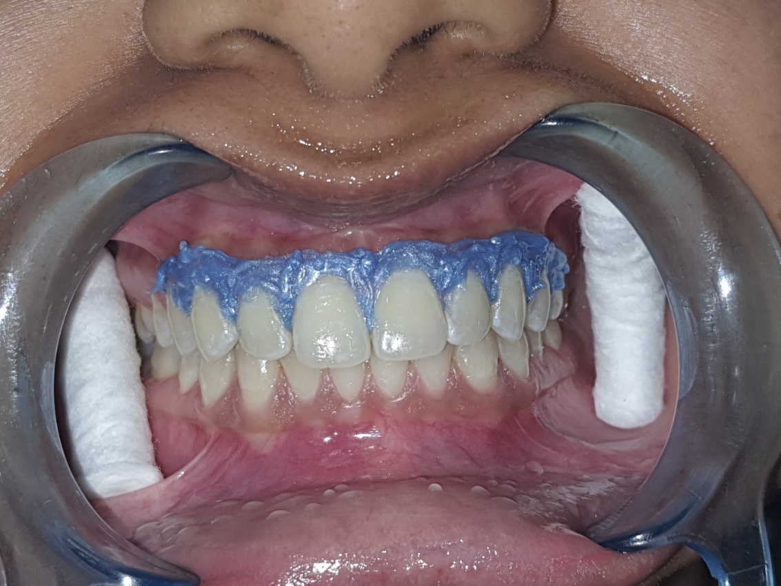 Dental Treatment