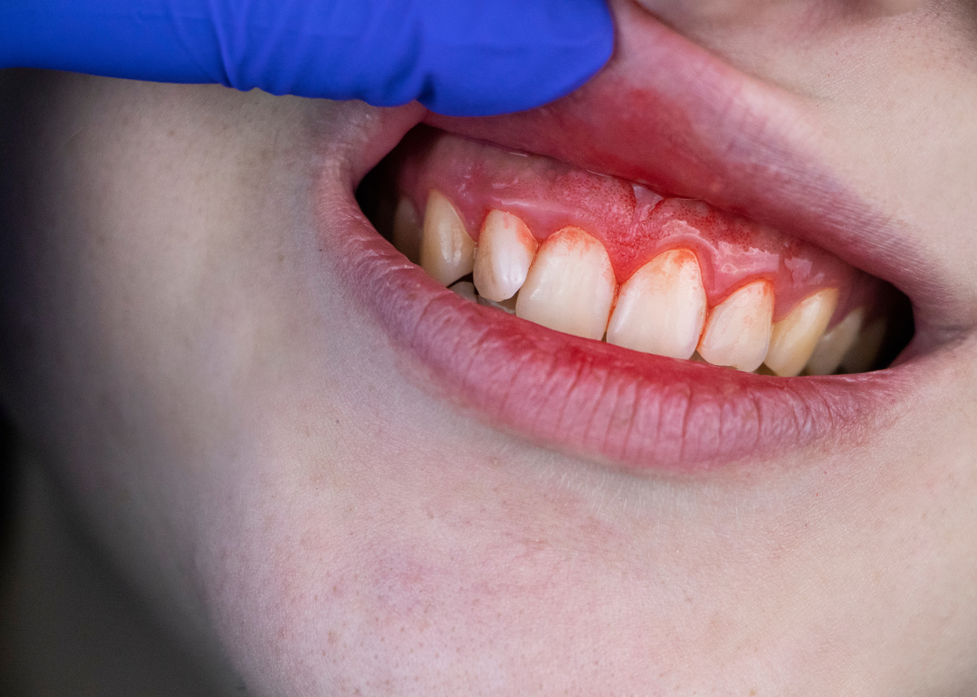 Periodontology
