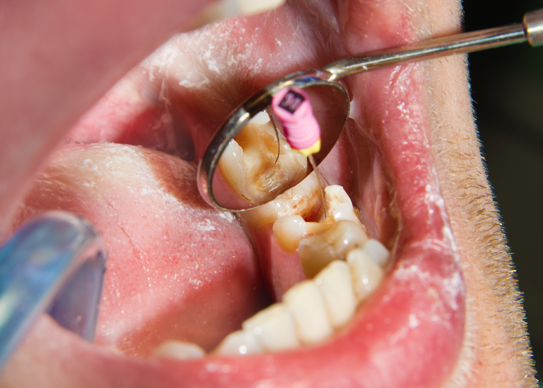 Endodontics