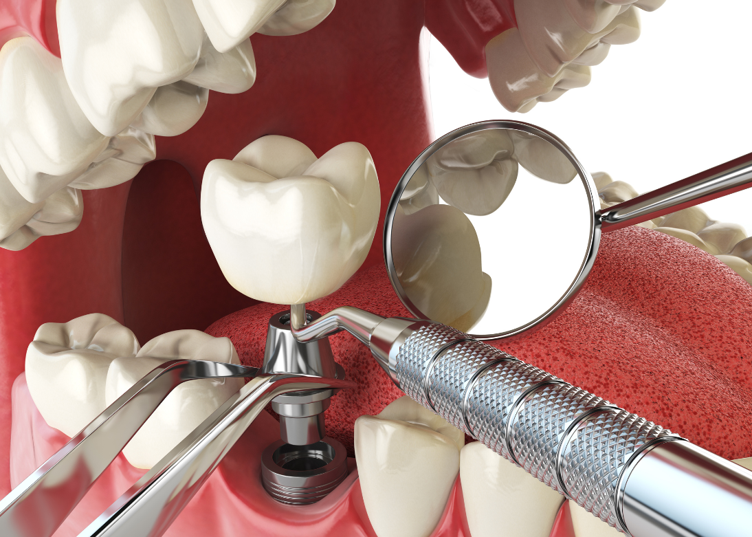 Implant Dentistry