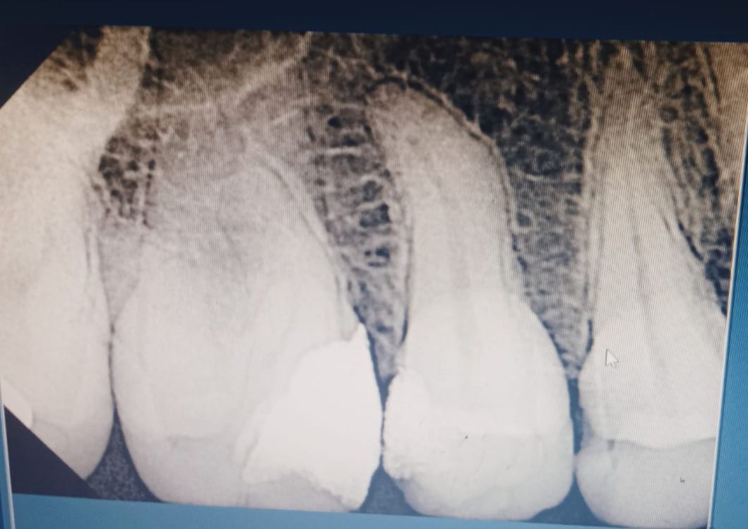 IOPA X-Ray